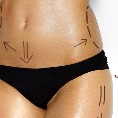 Liposuction (lipoplasty)