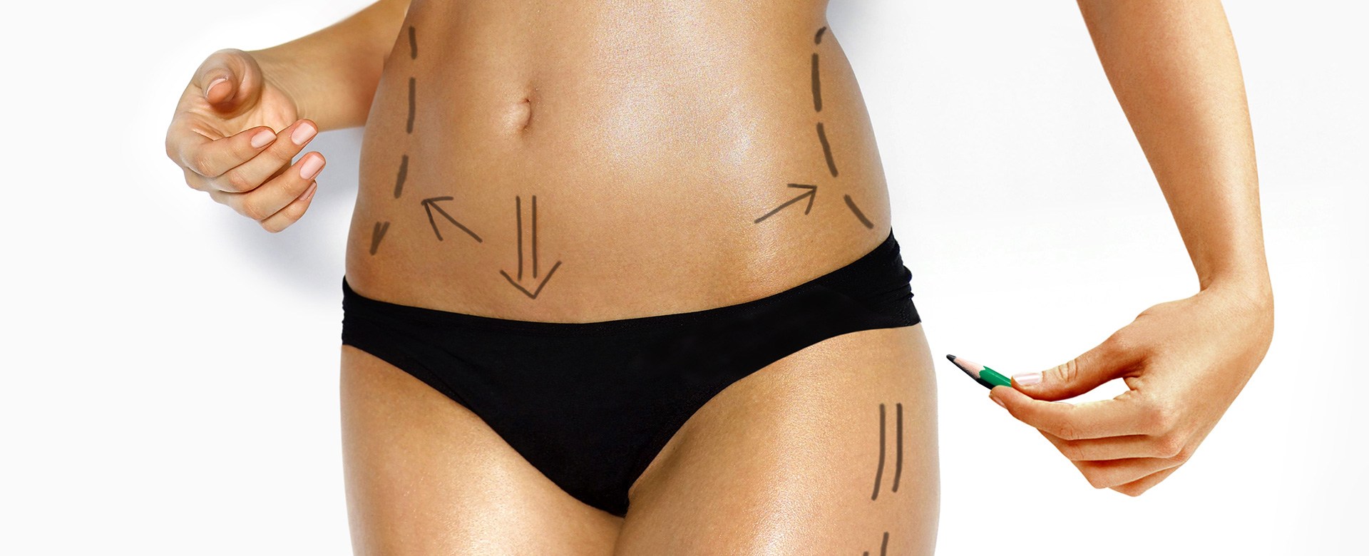 Liposuction (lipoplasty)