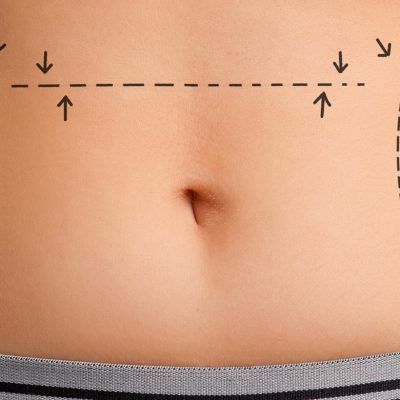 Tummy tuck (abdominoplasty)